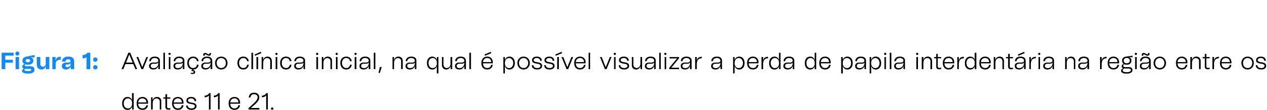 Figura 1: Avalia o cl nica inicial, na qual   poss vel visualizar a perda de papila interdent ria na regi o entre os...
