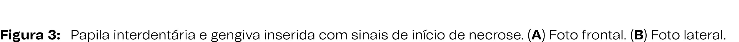 Figura 3: Papila interdent ria e gengiva inserida com sinais de in cio de necrose. (A) Foto frontal. (B) Foto lateral.