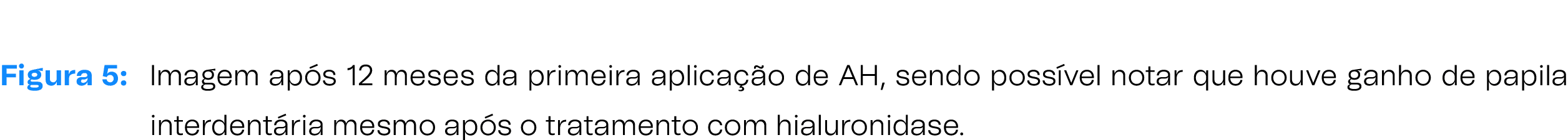 Figura 5: Imagem ap s 12 meses da primeira aplica o de AH, sendo poss vel notar que houve ganho de papila interdent ...